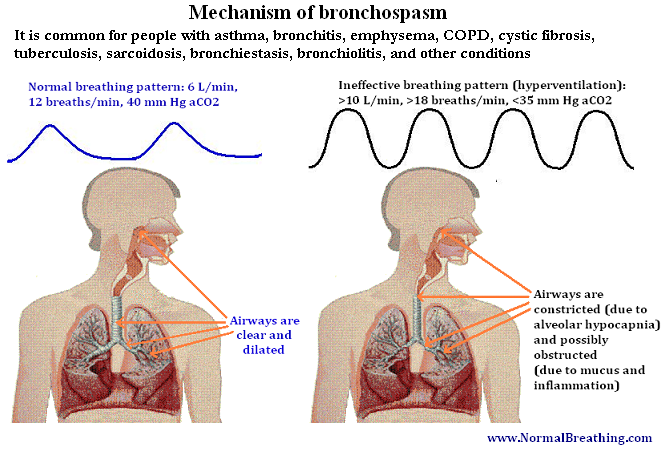 Bronchospasm Definition Symptoms Causes And Treatment